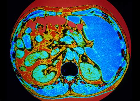 Ct Scan Of Human Adrenal Gland Photograph by Gca/science Photo Library