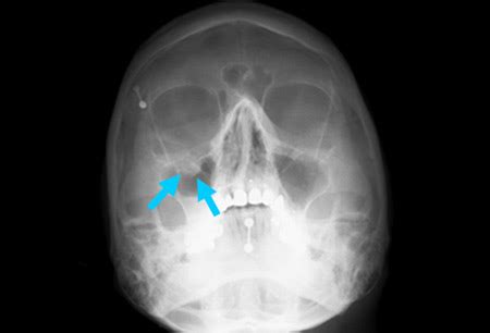 Orbital rim fracture - leryzen