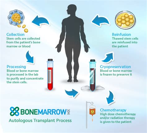 Risks of Stem Cell Transplants - Stem Cell Research