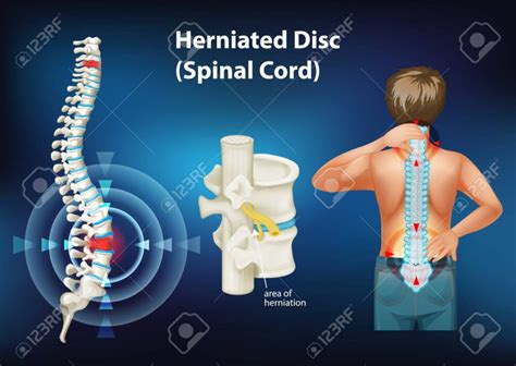 Stem Cell Treatment for Herniated Discs - Regenerative Orthopedic Institute