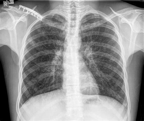 Chest X-Ray Projection | Chest X-Ray - MedSchool