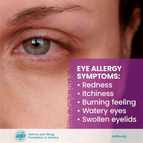 Itchy Eyes Allergy Symptoms Without