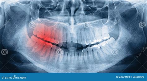 X-ray scan of teeth stock photo. Image of people, medicine - 23630408