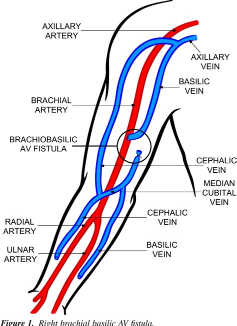 Figure 1 from AXILLARY ARTERY BRACHIAL ARTERY RADIAL ARTERY ULNAR ...