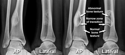 Imaging of Musculoskeletal Disorders - Bone tumours - Primary