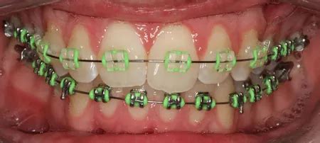 Braces Colours - Show off your personality with colour!