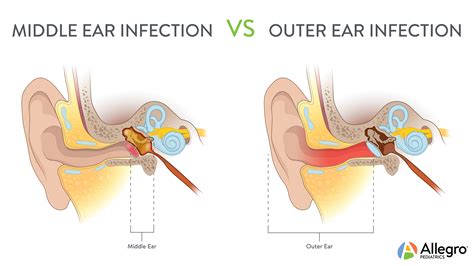 Ear Infections | Allegro Pediatrics