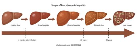 What Are The Stages Of Cirrhosis Of The Liver Sale Discount | educatel ...