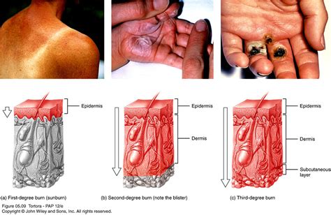 A Burn Affecting Only the Epidermis Is a - Jaylene-has-Simon