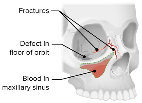 Orbital Fractures | Concise Medical Knowledge