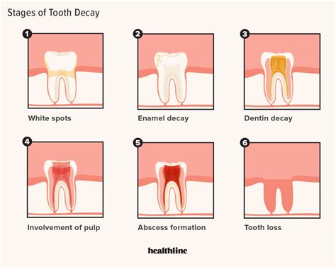 Why Does My Tooth Pain When I Bite Down? Reasons & Remedies