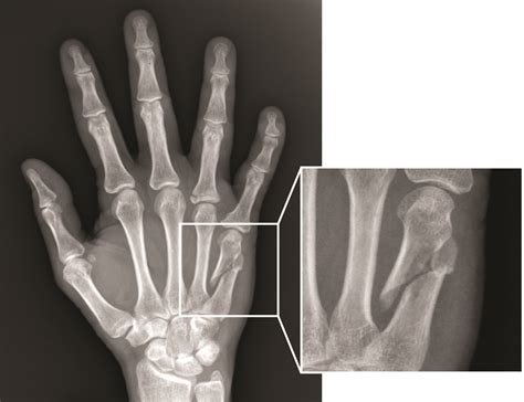 Broken Index Finger X Ray