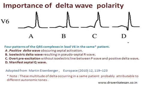 Delta wave blues in WPW syndrome : What is the relationship between ...