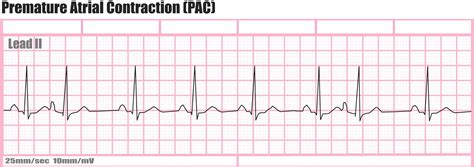 Ectopic Heartbeat - Causes, Symptoms, Diagnosis, Treatment