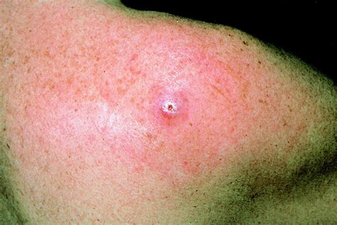 Furuncular myiasis caused by Dermatobia hominis, the human botfly ...