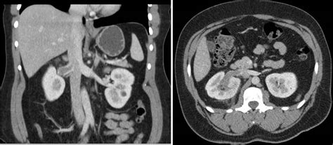 Renal Vein Thrombosis: Presentation, Causes and Treatment