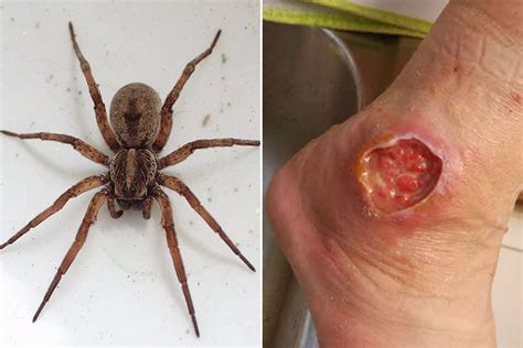 The worst spider bite pictures including the Brown Recluse and Black ...