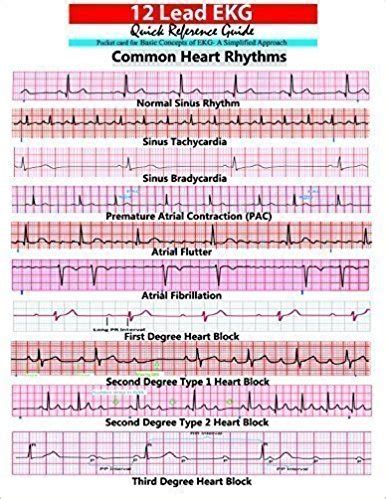 12 lead EKG Pocket Card - APRN world