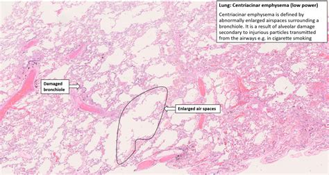 Emphysema Histology