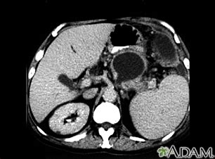 Normal Ct Scan Abdomen