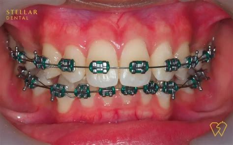 Braces Colors: Top Picks For 2023 - Stellar Dental