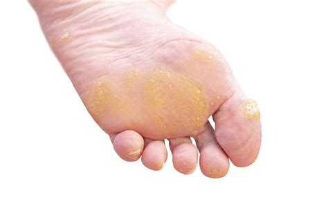 Corns & Callus - What Are They & How Do We Treat - The Healthcare Hub