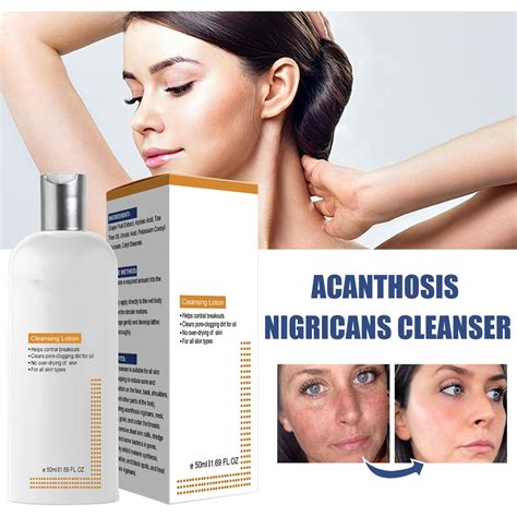 Cleansing Lotion For & Acanthosis Nigricans & Dark Natural Underarm For ...