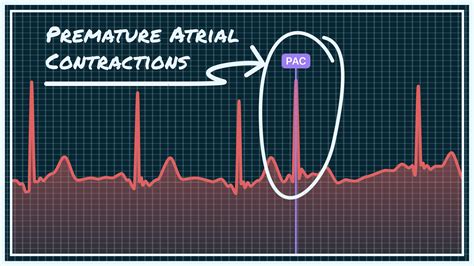 What Premature Atrial Contraction (PAC) Looks Like on Your Watch ECG | Qaly