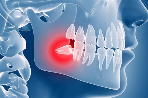 WisdomTeeth Removal - Elite Dental Care