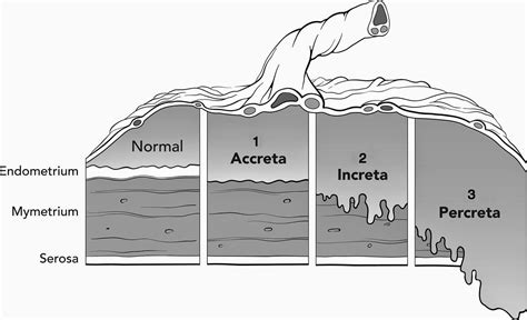 Placenta Accreta