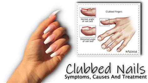 Clubbed Nails : Symptoms, Causes And Treatment - Fancy Nail Art