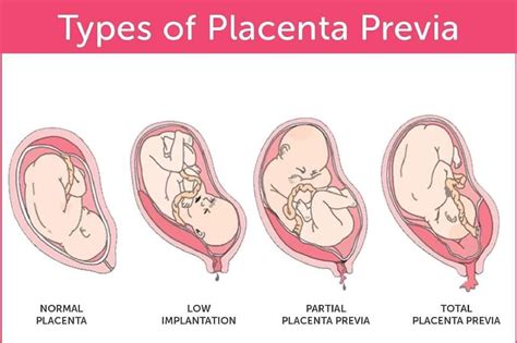 SOLUTION: Placenta previa nursing notes - Studypool