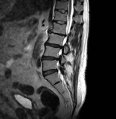 Lumbar Spine MRI scan | Medserena Open MRI