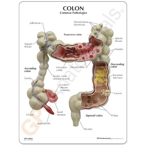 Human Colon Anatomical Model with Pathologies