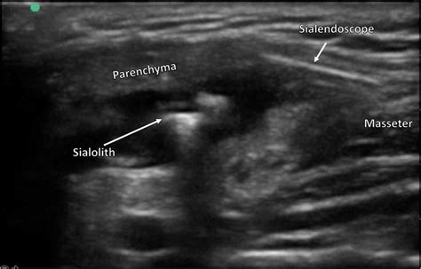 Sialendoscope seen within the parotid duct on intraoperative ultrasound ...