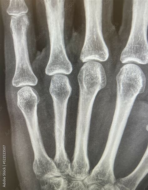 x ray of a broken bone in a human hand Stock Photo | Adobe Stock