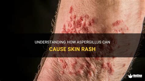 Understanding How Aspergillus Can Cause Skin Rash | MedShun