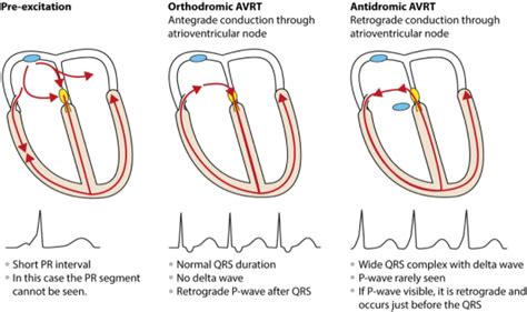 Atrial Fibrillation in WPW Syndrome - Pearls and Pitfalls - County EM