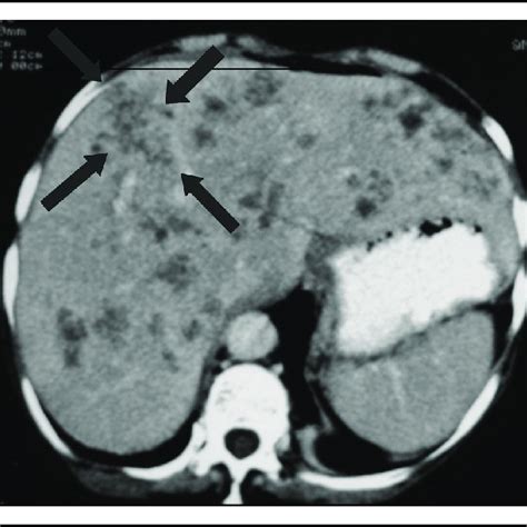 Late stage of acute fasciola infection (5 months of symptoms ...