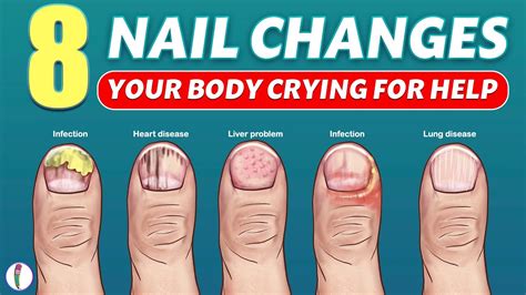 Nail signs of Disease | Nail pitting | Finger clubbing | Signs of ...