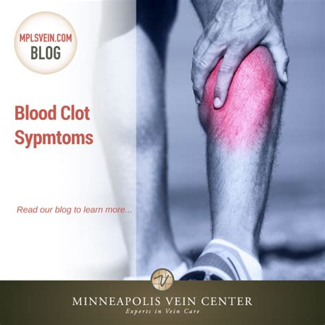 Blood Clot Symptoms: Minneapolis Vein Center: Interventional Radiologists