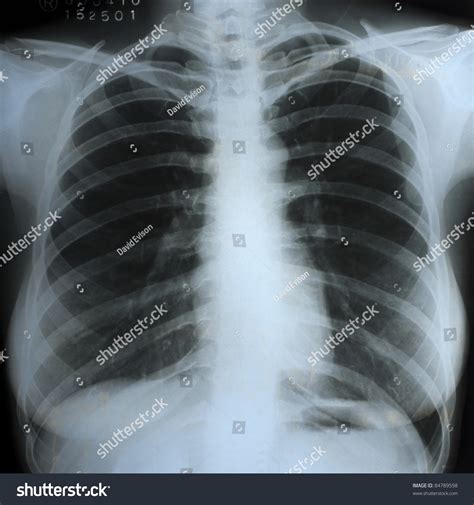 A Chest Xray Scan For A Medical Diagnosis. Stock Photo 84789598 ...