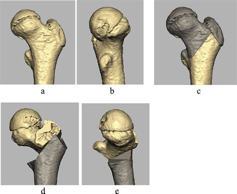 Preoperative planning of rotational osteotomy of the femoral head. In ...