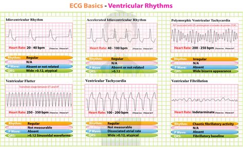 Ventricular Rhythms | Ekg interpretation, Ecg rhythms, Nursing mnemonics