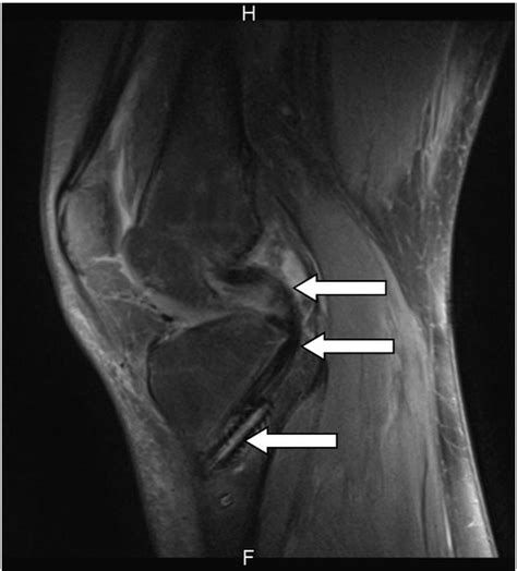 Posterior Cruciate Ligament (PCL) – St. Catherine