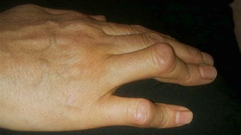 Rheumatoid Arthritis Hand Deformities: What to Do