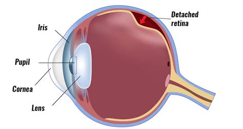 Detached retina - Symptoms, Causes & Treatment.