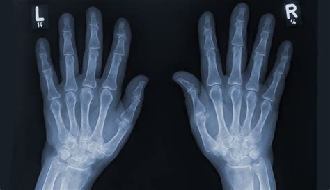 Hand X-Ray: Anatomy, Procedure & What To Expect