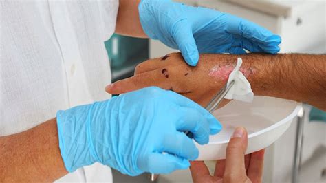 Denuded Wounds: Nurses' Role in Treatment & Prevention