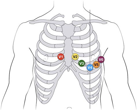 ECG Lead positioning • LITFL • ECG Library Basics